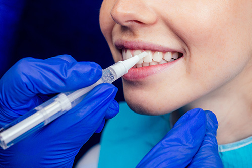 Blanqueamiento dental seguro